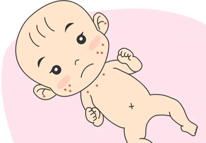育儿小知识：夏季困扰胖宝宝的六大肌肤问题